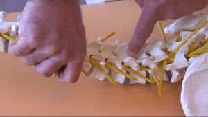 Listen to a doctor explain the causes and treatment for a type of back pain called lordosis