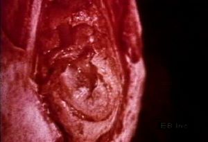 Watch tympanic membrane and auditory ossicles transmit sound wave vibrations to the human inner ear