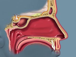Learn how the olfactory bulb in the brain processes the information from the olfactory receptors lining the nose